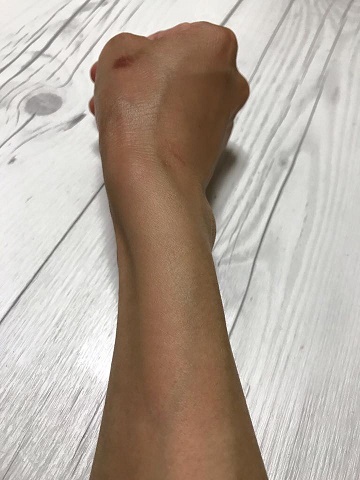 初診から一週間後の右手（ほぼ正常）
